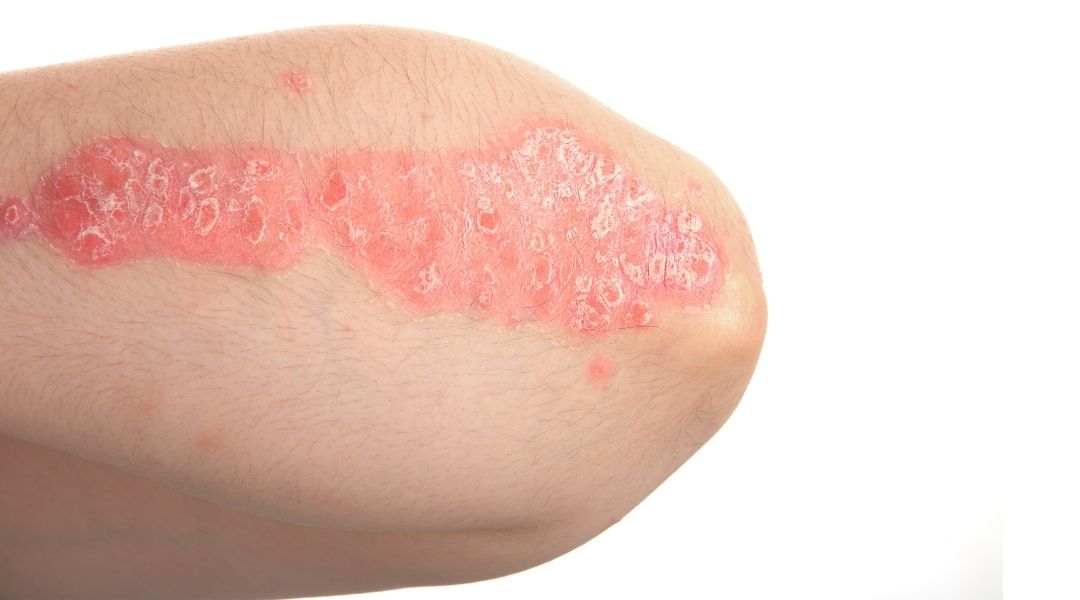 psoriasis