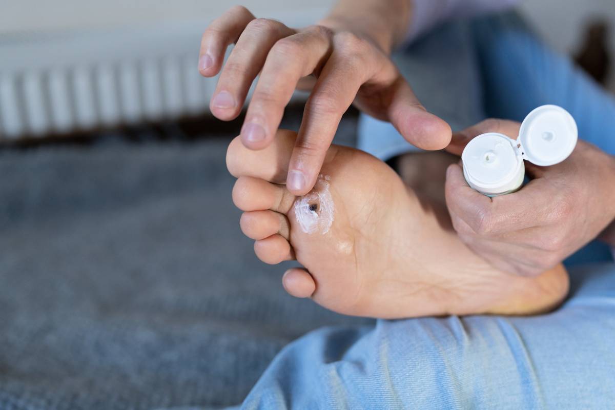 Une personne met de la pommade sur sa verrue sous le pied